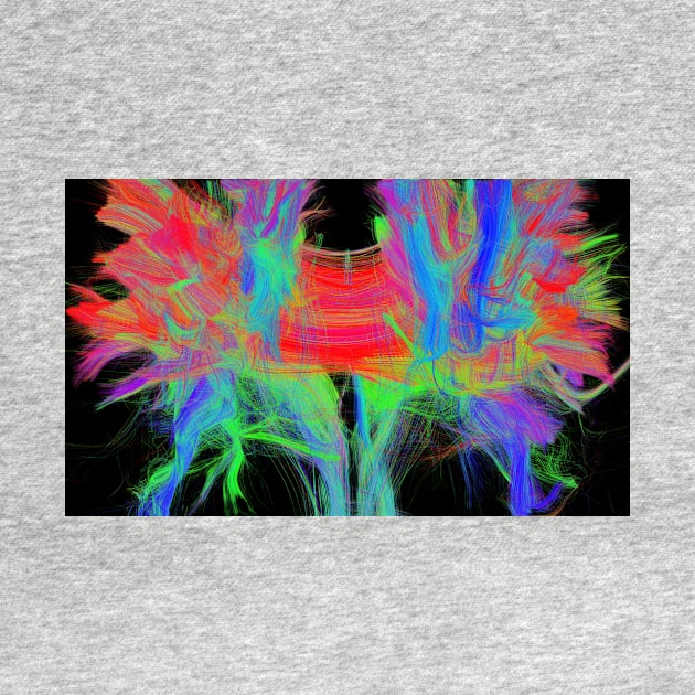 Corpus callosum, DTI MRI scan (C017/7044) by SciencePhoto